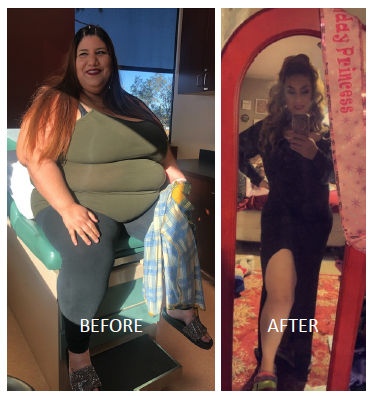 Jasmine Jimenez, before and after her gastric bypass surgery