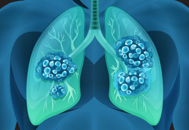 Actualmente se encuentran disponibles exámenes de CT de dosis bajas para cáncer de pulmón